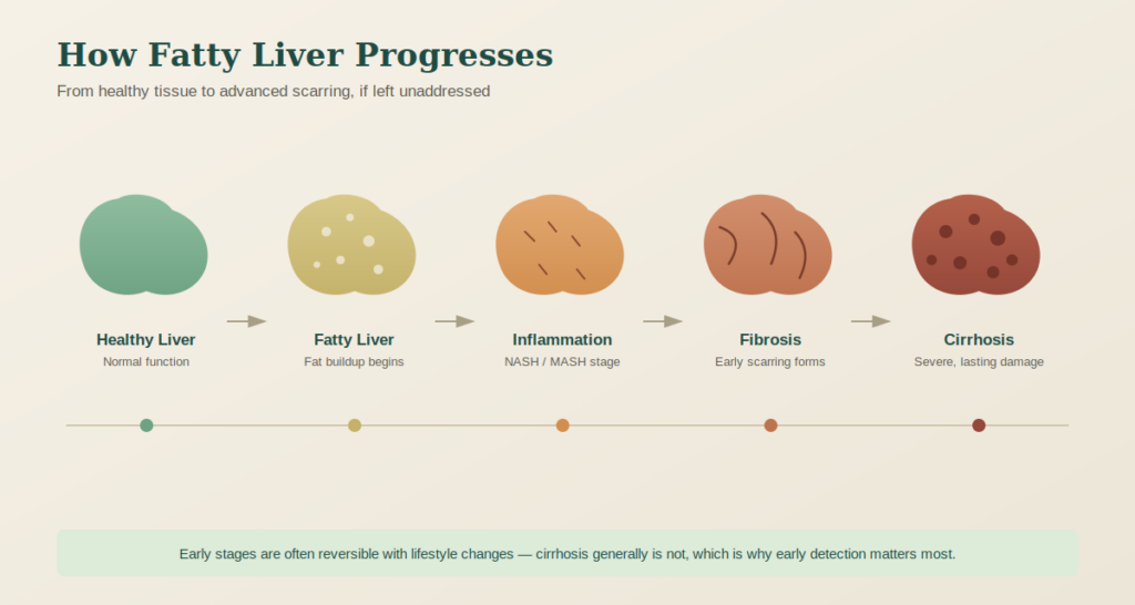 Infographic showing five stages of fatty liver disease progression — healthy liver, fatty liver, inflammation, fibrosis, and cirrhosis